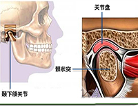 顳下頜關(guān)節(jié)紊亂病